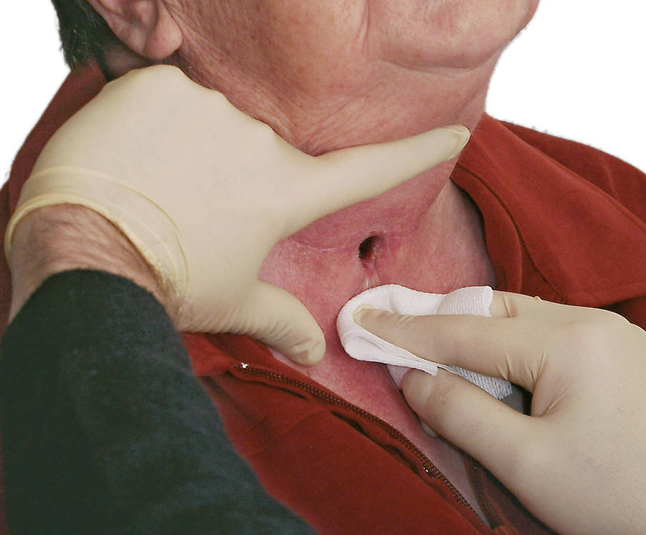 Reinigung Pflege eines Tracheostoma