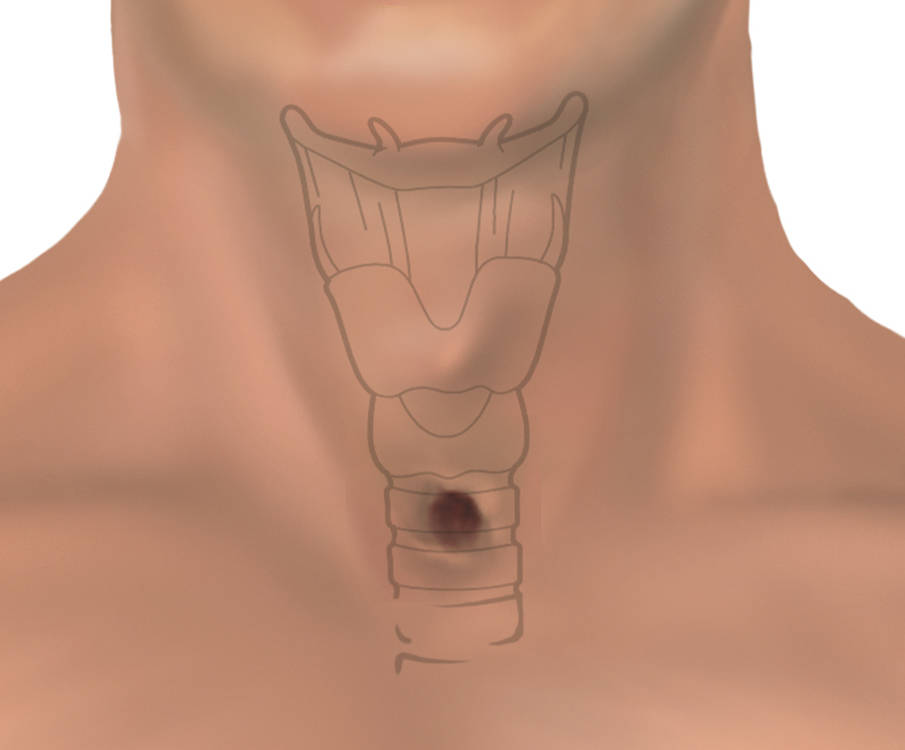 Skizze Lage eines Tracheostomas